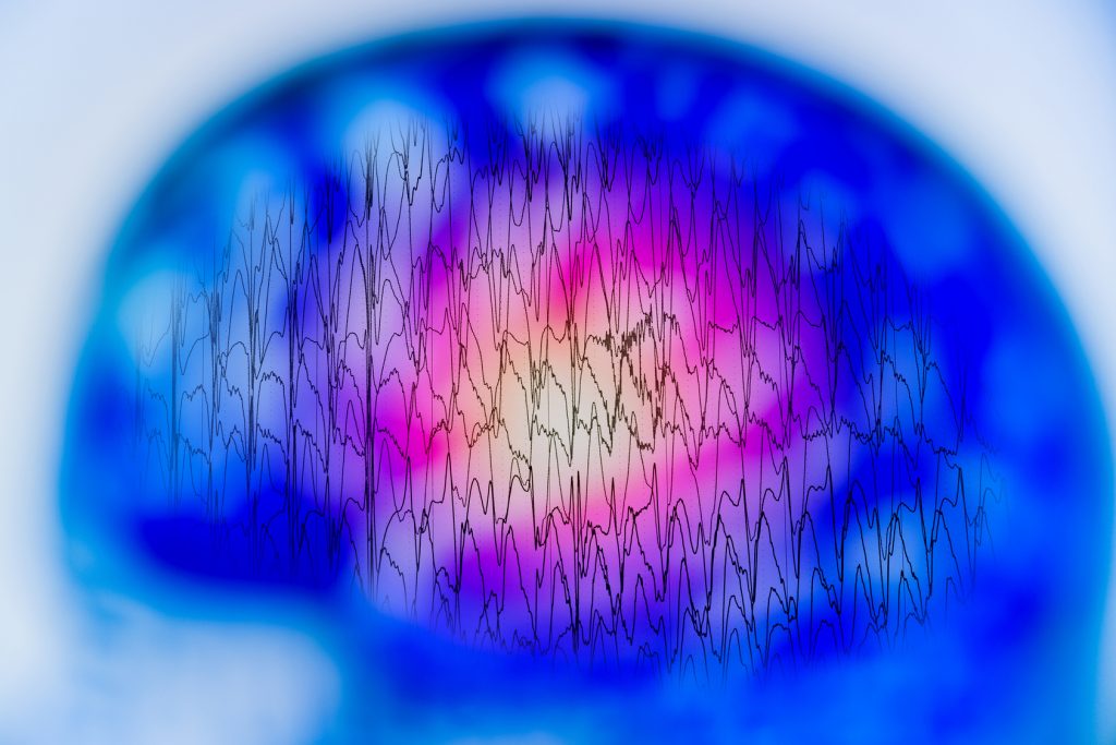 abnormal-eeg-brain-wave-actions